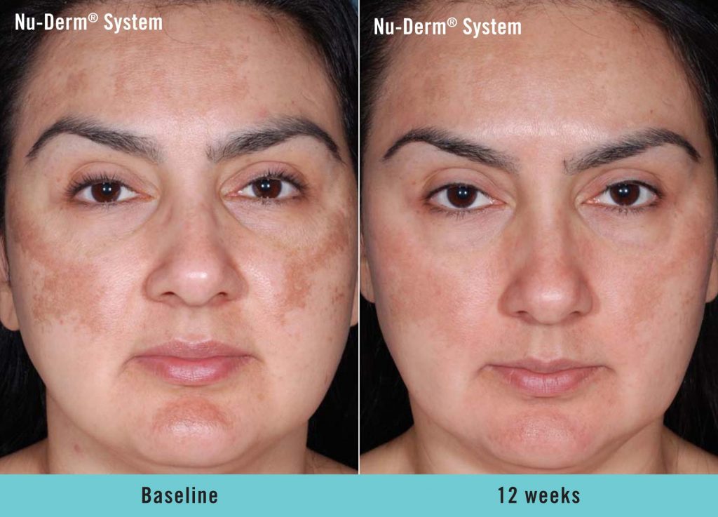 Obagi Complete Skin Transformation Kit