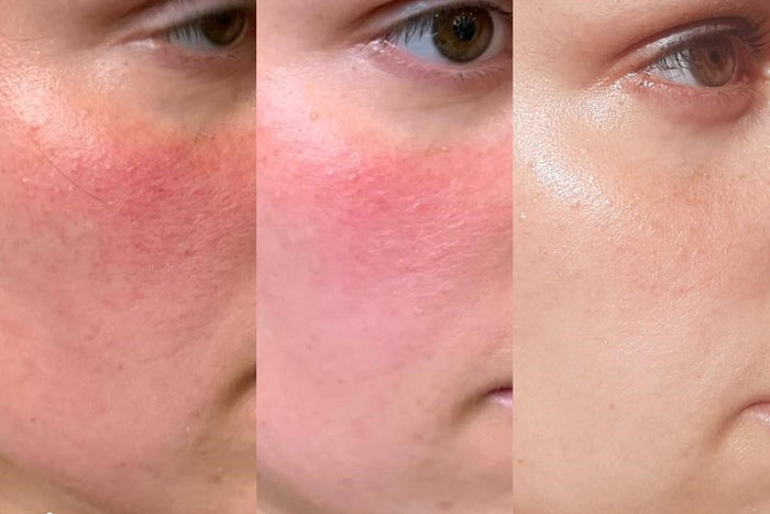 Opplev rosacea lindring utført av våre eksperter i Sandvika. Book time og nyt en luksuriøs opplevelse.
